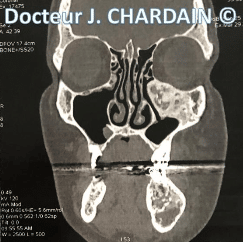 Dysplasie fibreuse hémifaciale gauche - Dr Chardain Nogent-sur-Marne