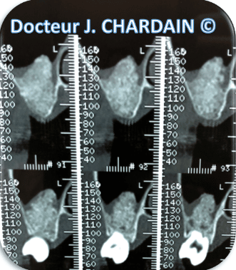 Radio d'un sinus lift pour greffes osseuses - Dr Chardain Nogent-sur-Marne