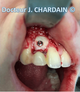Greffes d’apposition pour chirurgie implantaire et greffes osseuses par Dr Chardain à Nogent-sur-Marne