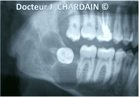Radio d'un Kyste folliculaire de la dent de sagesse à Nogent-sur-Marne - Dr Chardain