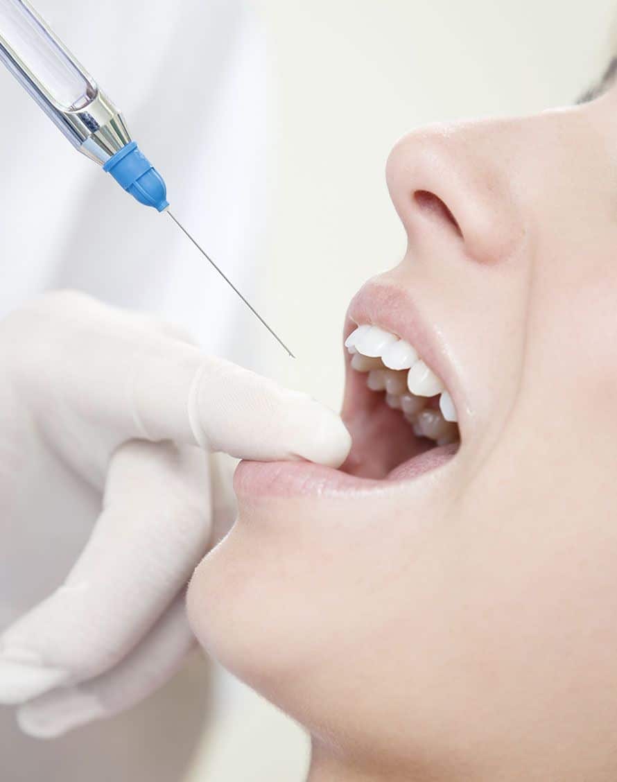 Anesthésie locale pour la chirurgie des dents de sagesse - Dr Chardain
