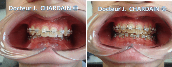 Dents d'une patiente avec une classe III squelettique hyperdivergente - Dr Chardain Nogent-sur-Marne