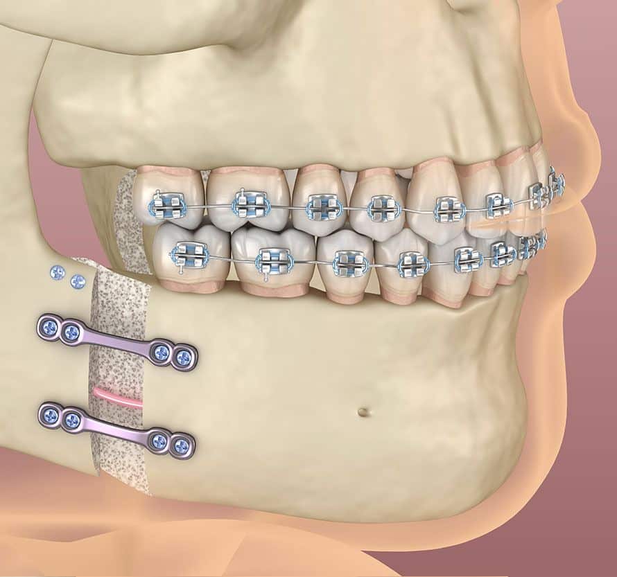 Ostéotomie mandibulaire pour correction de la machoire - Dr Chardain Nogent-sur-Marne