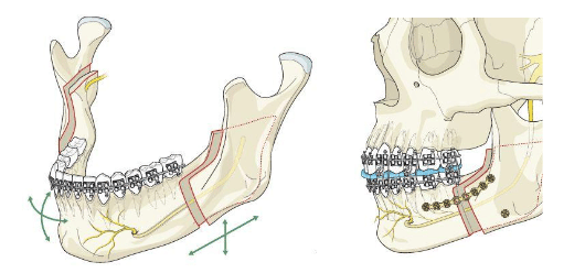 Schéma d'une Ostéotomie mandibulaire - Dr Chardain Nogent-sur-Marne