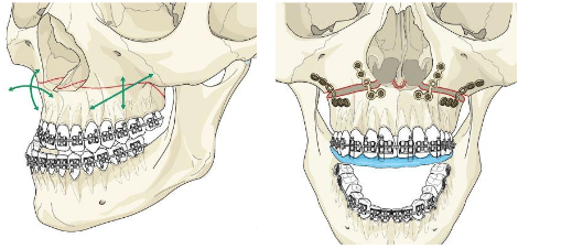 Schéma d'une Ostéotomie maxillaire - Dr Chardain Nogent-sur-Marne