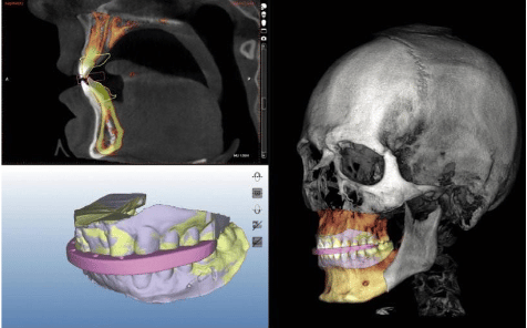Moulages 3D pour la chirurgie orthognathique guidée - Dr Chardain Nogent-sur-Marne