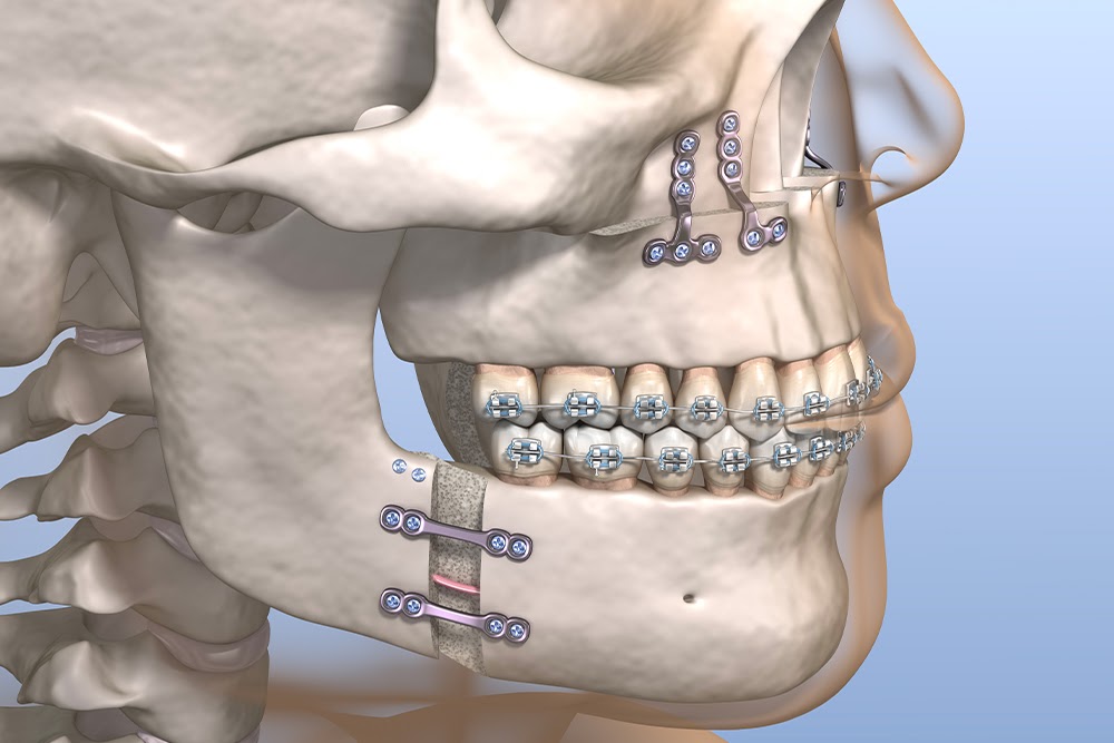 Qu’est-ce qu’une ostéotomie bi-maxillaire ? | Dr Chardain | Nogent sur Marne