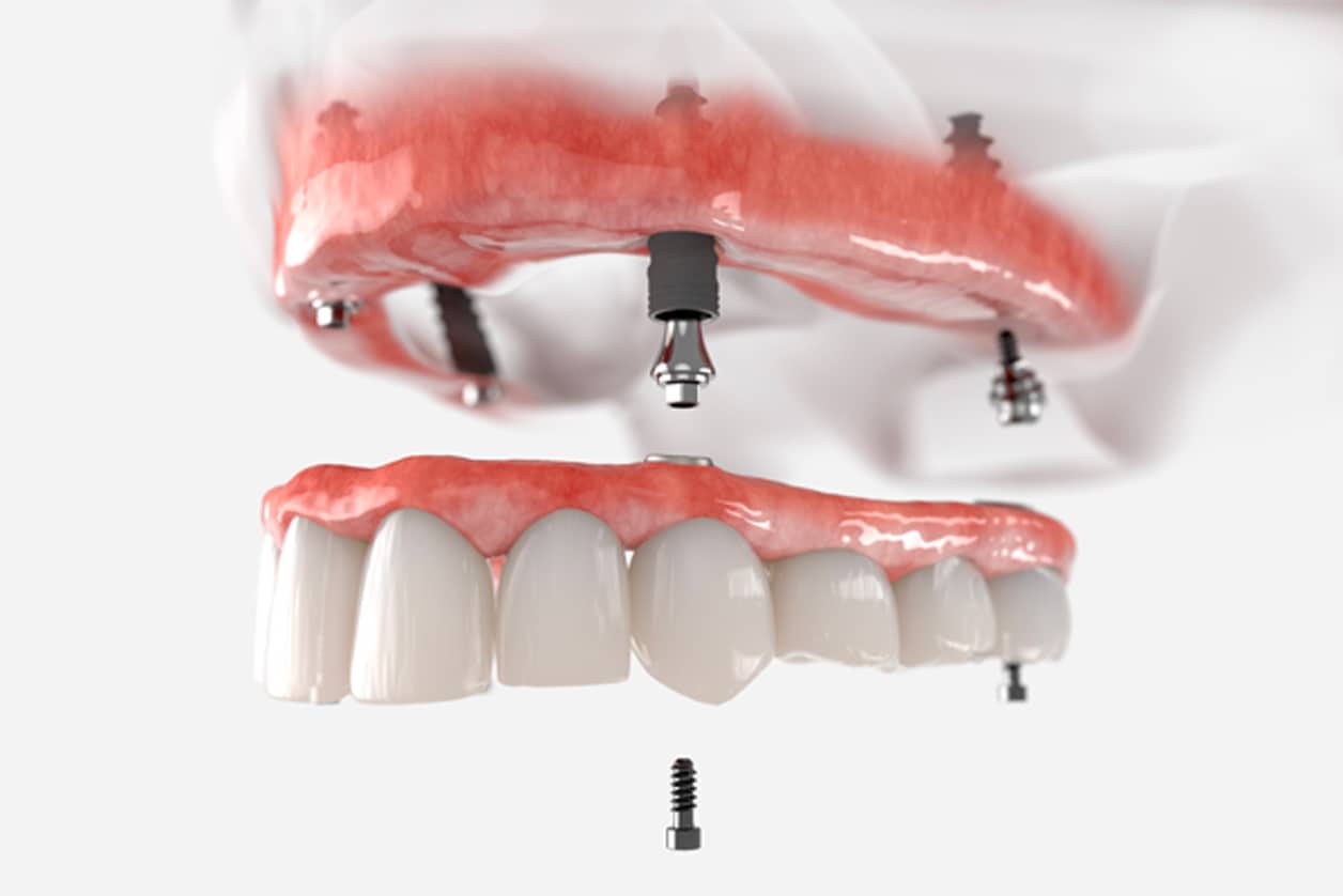 La réhabilitation implantaire complète du maxillaire | Dr Chardain