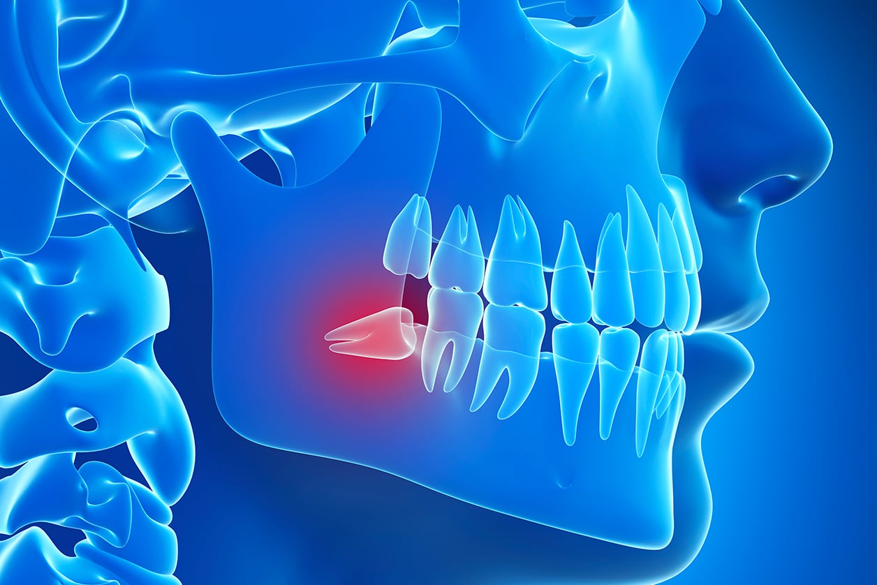 Découvrez les indications, modalités et les suites post-opératoire de l’extraction des dents de sagesse | Dr Chardain