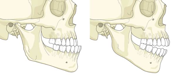 Découvrez à gauche un maxillaire trop en retrait et à droite une béance nécessitant une ostéotomie bi-maxillaire | Dr Chardain | Nogent sur Marne